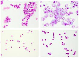 CSF Total Leucocyte Count Test – Accurate White Blood Cell Analysis in Cerebrospinal Fluid for Neurological & Infectious Diagnosis