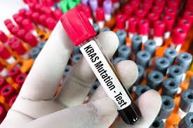 KRAS mutation analysis